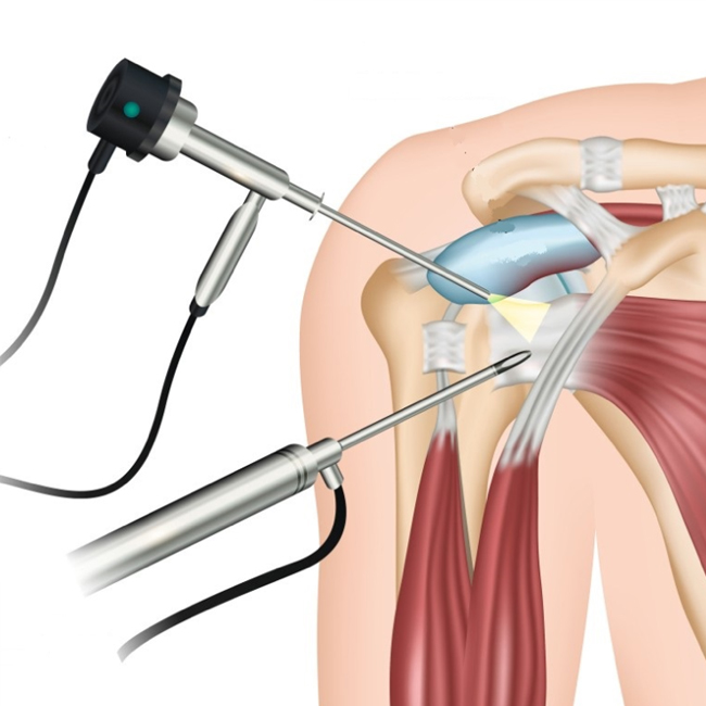 Acromioplastia Acromioplastia